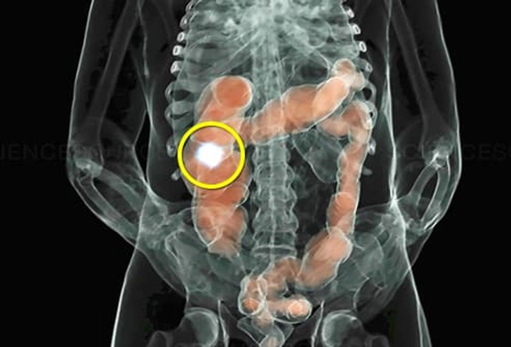 Carcinoid Tumors Carcinoid Tumors