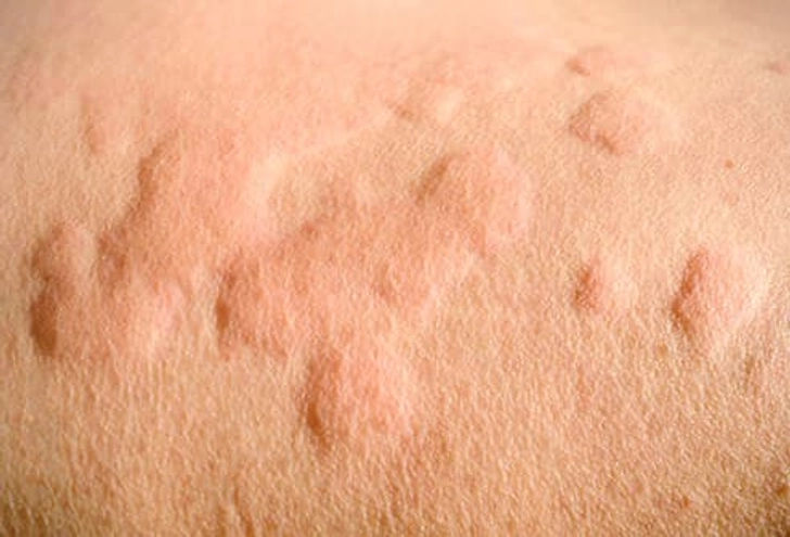 Allergic Reaction