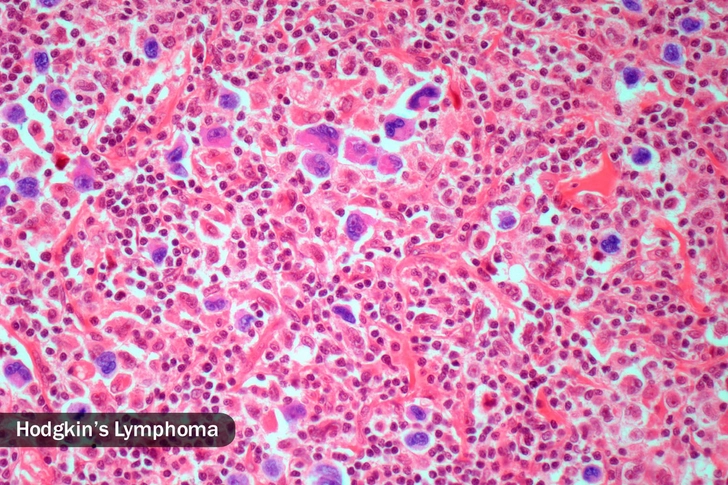 Lymphoma