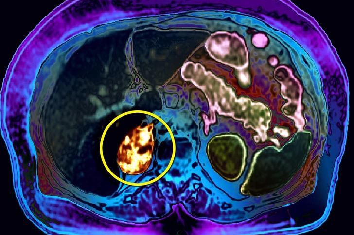 Pheochromocytoma
