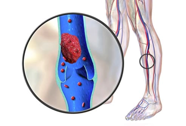 Deep Vein Thrombosis (DVT) Deep Vein Thrombosis (DVT)