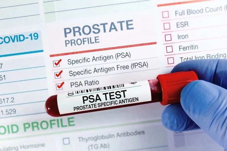 The Purpose of PSA Testing