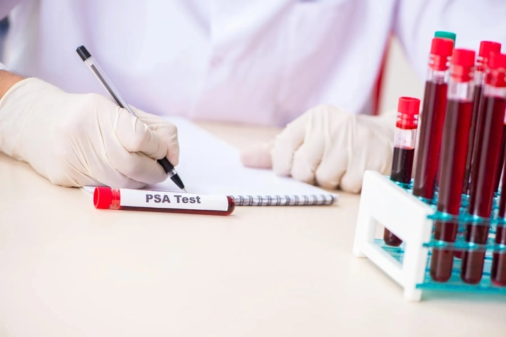 The Importance of PSA Velocity and Doubling Time Tests