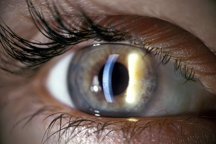 Slit-Lamp Exam