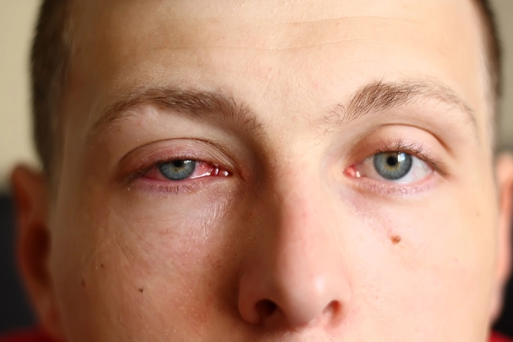 Eyes -- Yours and Others' -- Could Be Affected Eyes -- Yours and Others' -- Could Be Affected