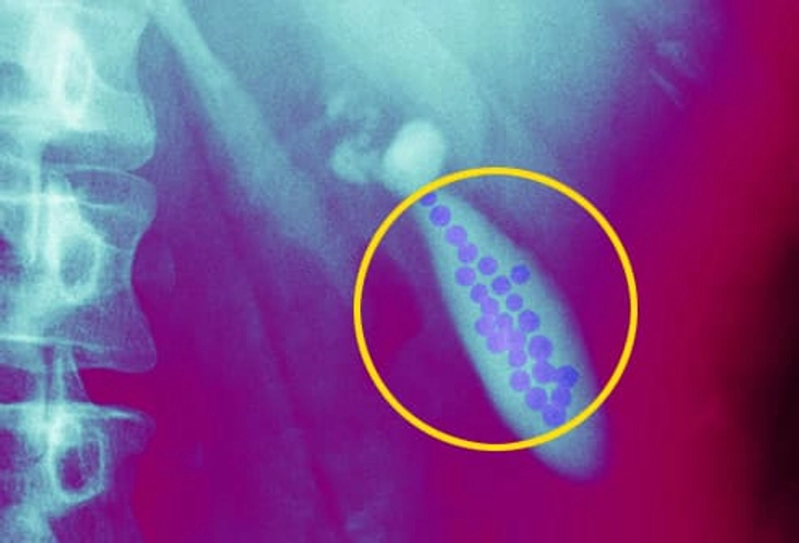 Links to Gallstones