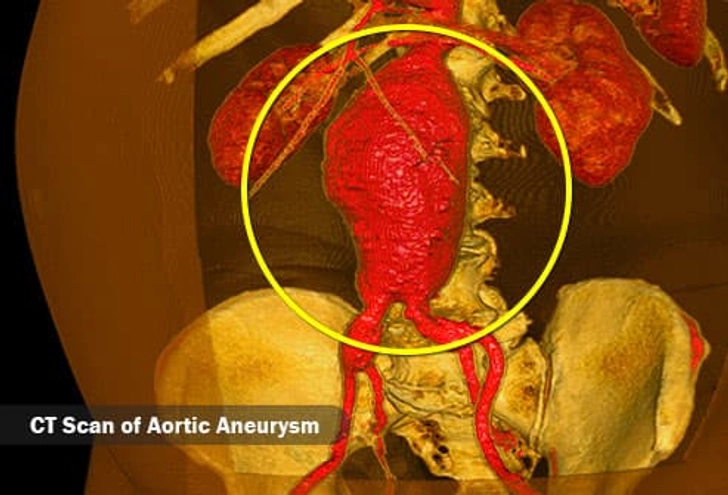 Aneurysm