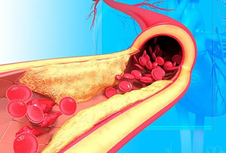 Artery Damage