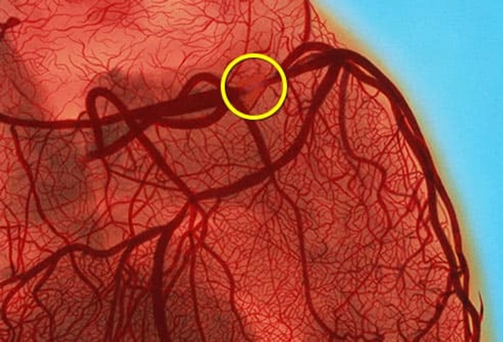 Coronary Artery Disease (CAD)