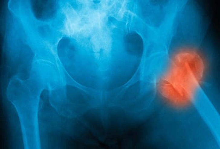 Bone Loss Bone Loss