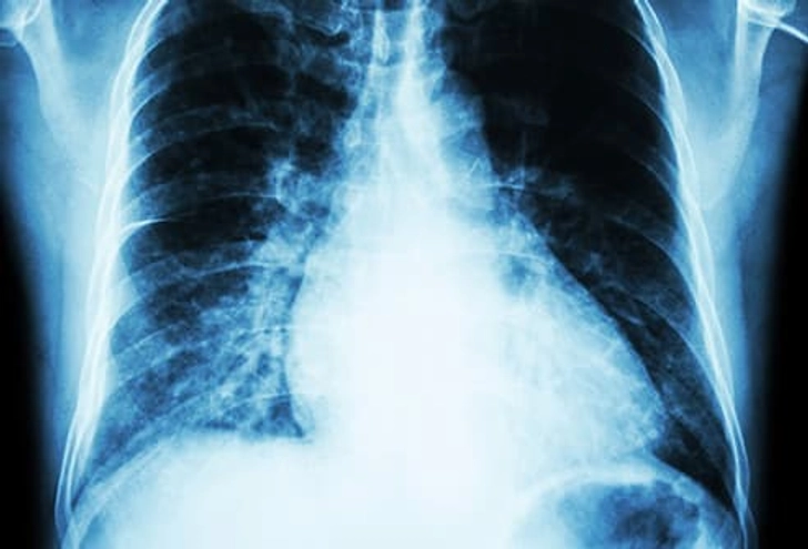 Enlarged Heart