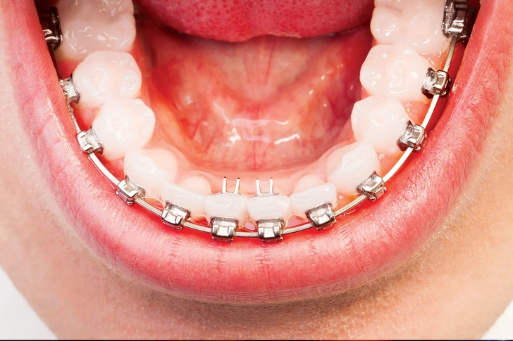 Is It My Braces?
