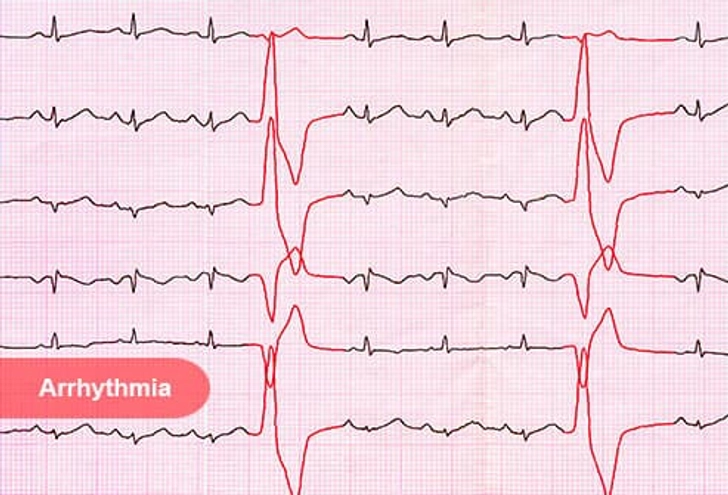 Arrhythmia