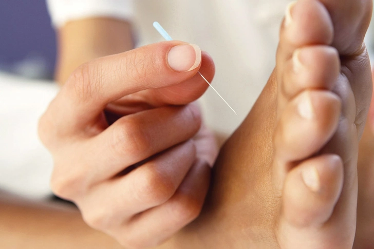 Acupuncture
