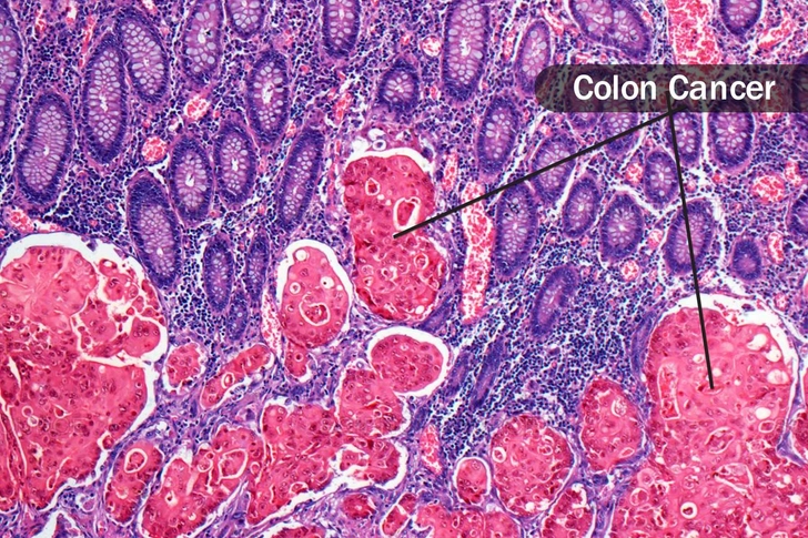 Why You May Need a Biopsy