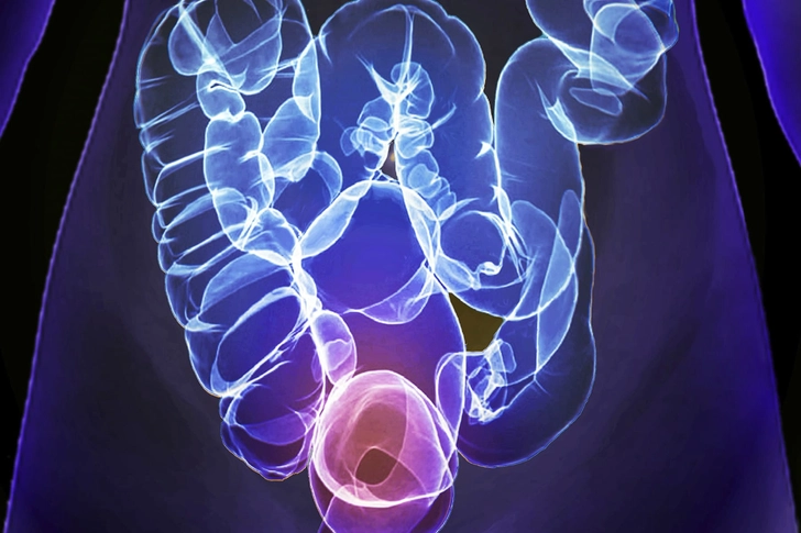 CT Scan (Virtual Colonoscopy)