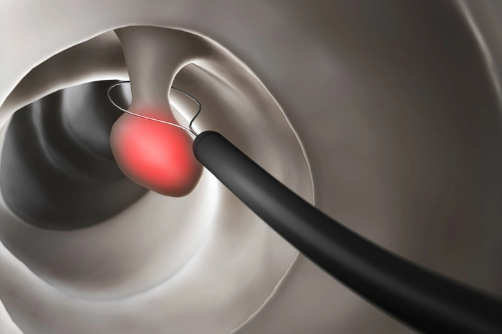 Why You Need to Remove Polyps