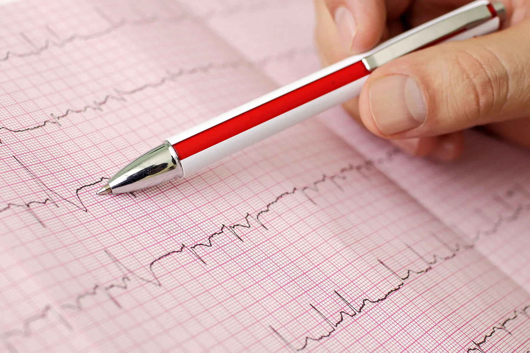 photo of arrhythmia readout