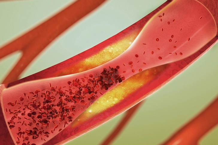 Causes of Arrhythmia Causes of Arrhythmia