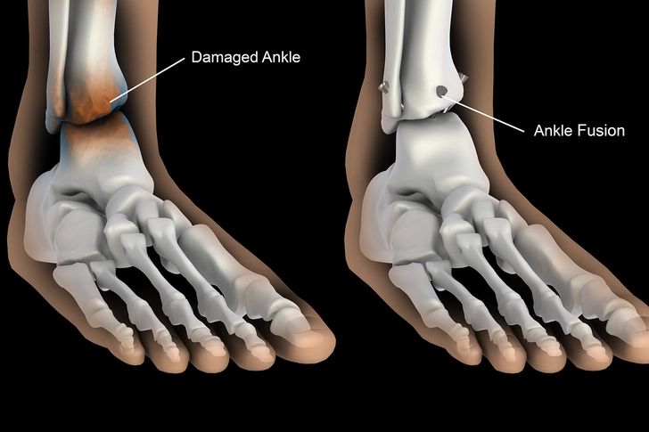 Joint Fusion (Arthrodesis)