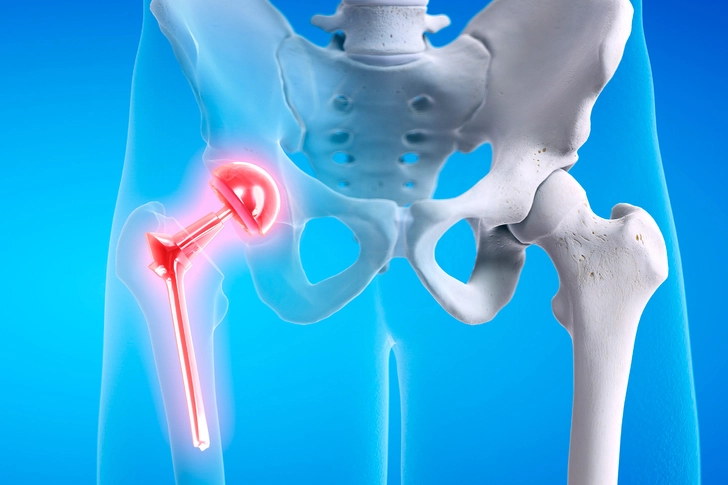 Joint Replacement Surgery (Arthroplasty) Joint Replacement Surgery (Arthroplasty)