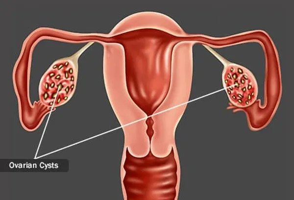 polycystic ovaries