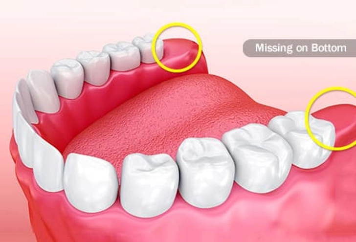 Missing Molars Missing Molars