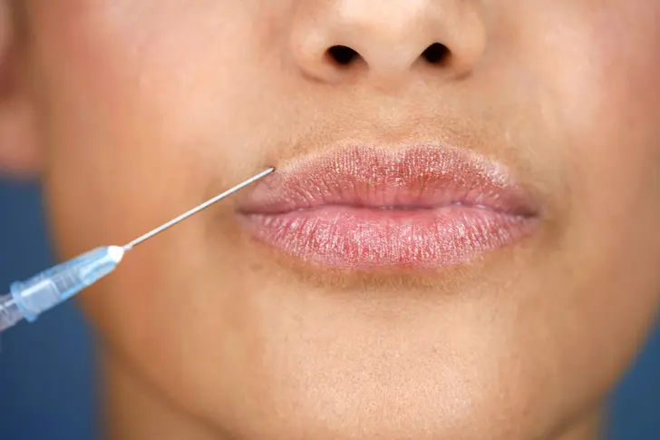 Types of Facial Fillers