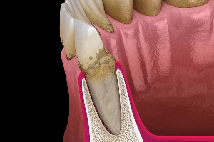 Bad Breath: A Sign of Something Serious