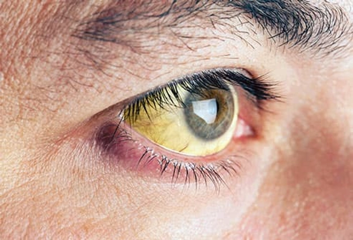 Yellow Whites of Your Eyes Yellow Whites of Your Eyes