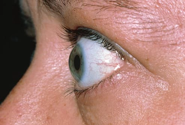 Bulging Eyes Bulging Eyes