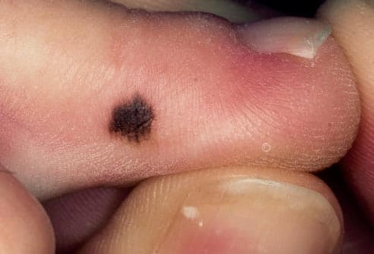 Dark Spot on the Foot Dark Spot on the Foot