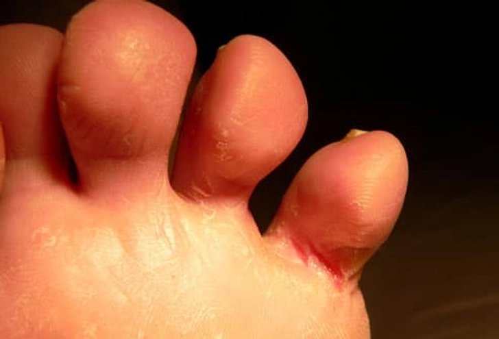 Itchy Feet Itchy Feet