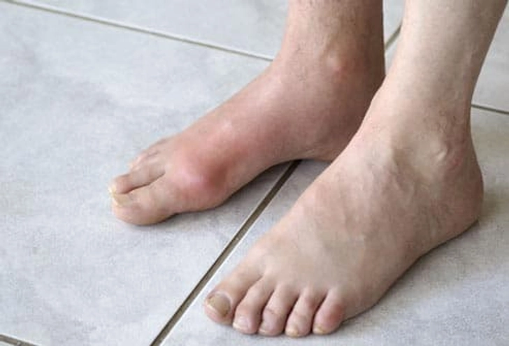 Pain in the Big Toe Pain in the Big Toe