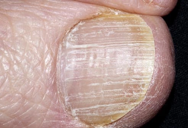 Pitting of the Nails Pitting of the Nails