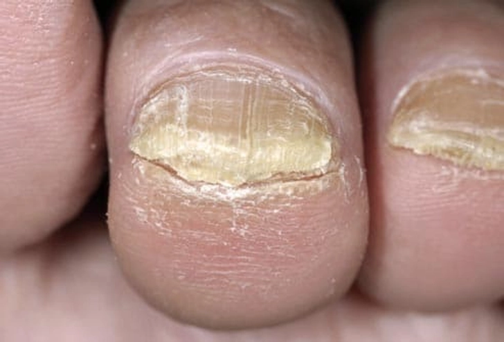Yellow Toenails Yellow Toenails