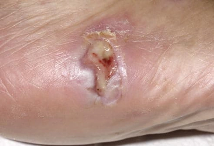Sores That Don't Heal Sores That Don't Heal