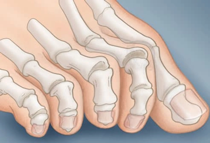 Claw Toe Claw Toe