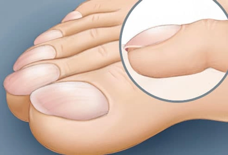 Clubbed Toes Clubbed Toes