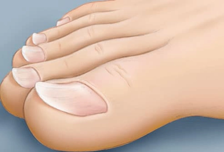 Spoon-shaped Toenails Spoon-shaped Toenails