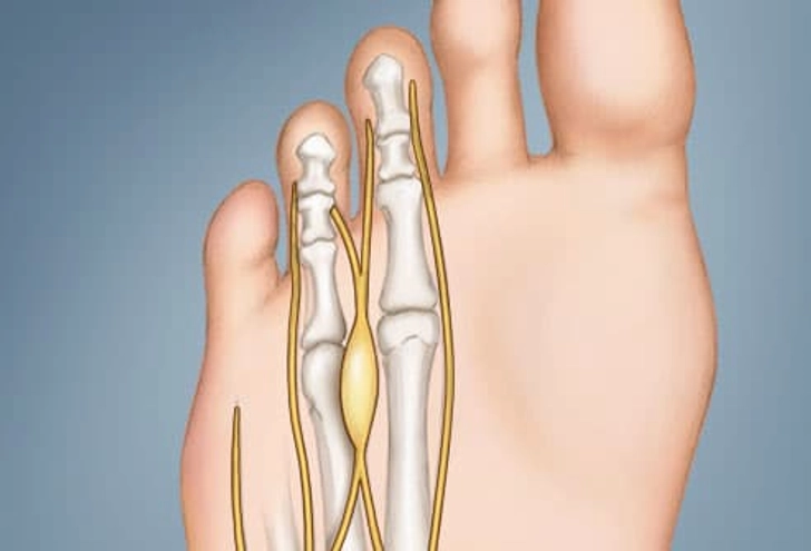 Pain in the Smaller Toes Pain in the Smaller Toes