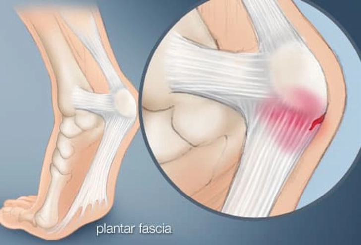 Heel Pain