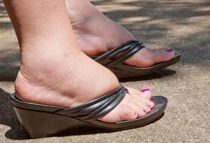 Swollen Feet Swollen Feet