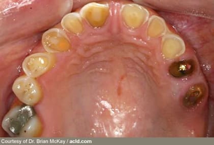 Eating Disorders Erode Tooth Enamel Eating Disorders Erode Tooth Enamel