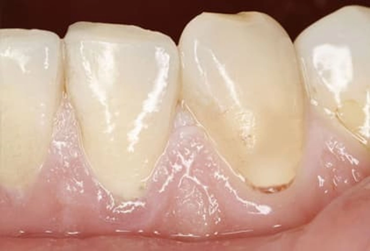 Pale Gums and Anemia Pale Gums and Anemia