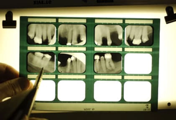 Tooth Loss and Kidney Disease Tooth Loss and Kidney Disease