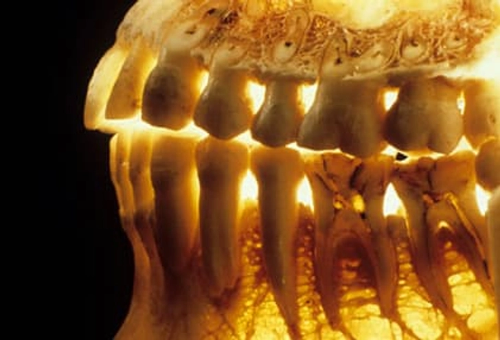Osteoporosis and Tooth Loss Osteoporosis and Tooth Loss