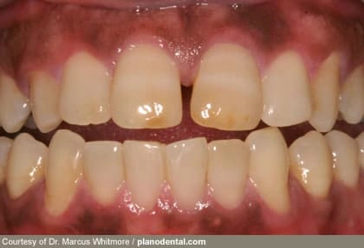 Gum Disease and Diabetes Gum Disease and Diabetes
