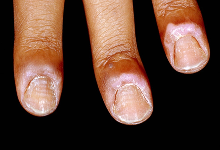 Puffy Nail Fold Puffy Nail Fold