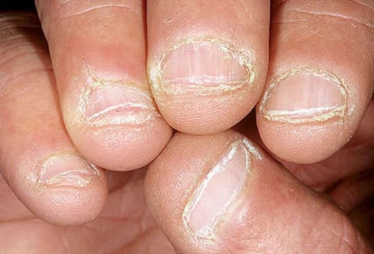 Gnawed Nails